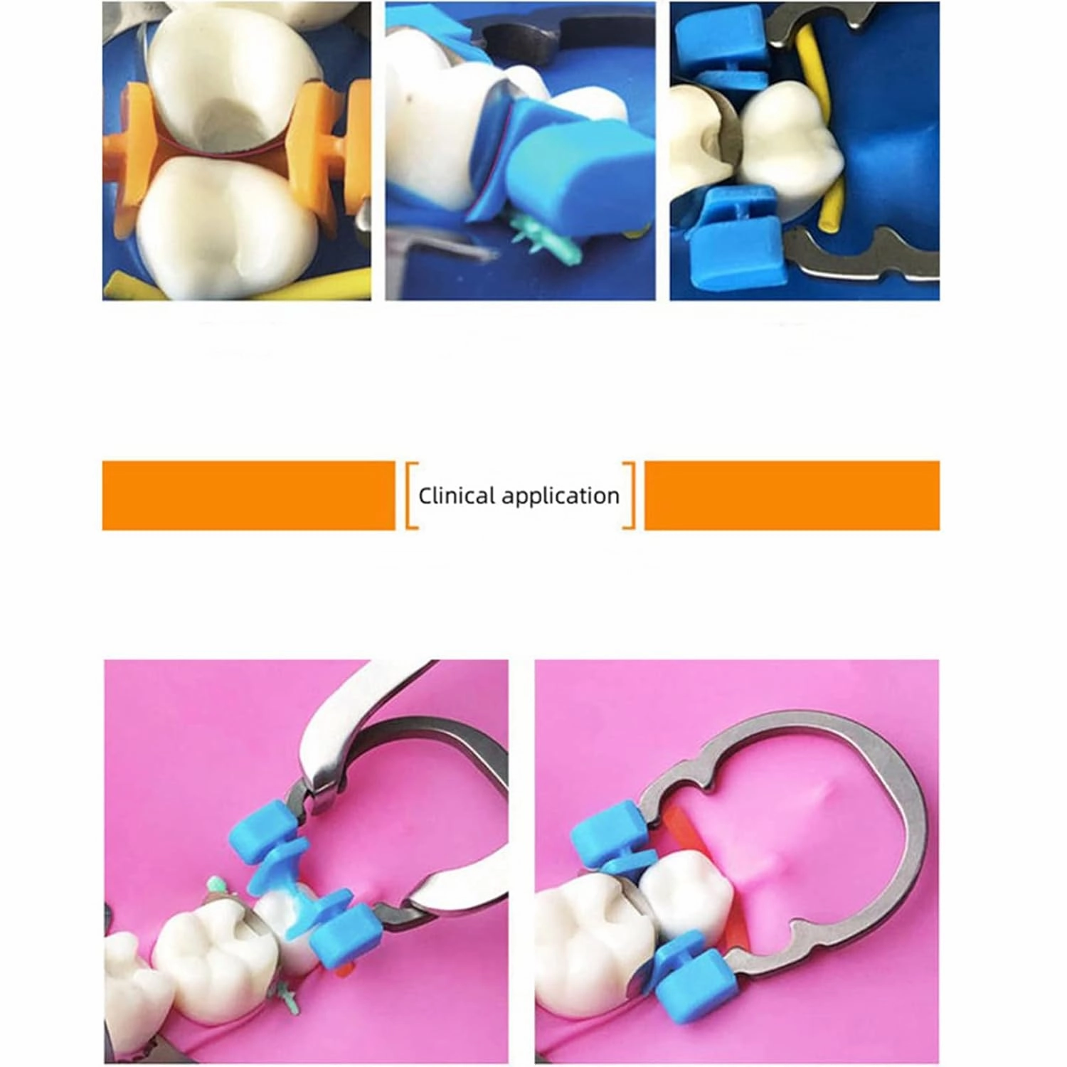 Dental Sectional Matrix Ring Clamp Spring Clip, Autoclavable Nickel Titanium Orthodontic Clamp Rings, Contoured Matrices System for Pre and Post Molars. (R2 Blue Orange)