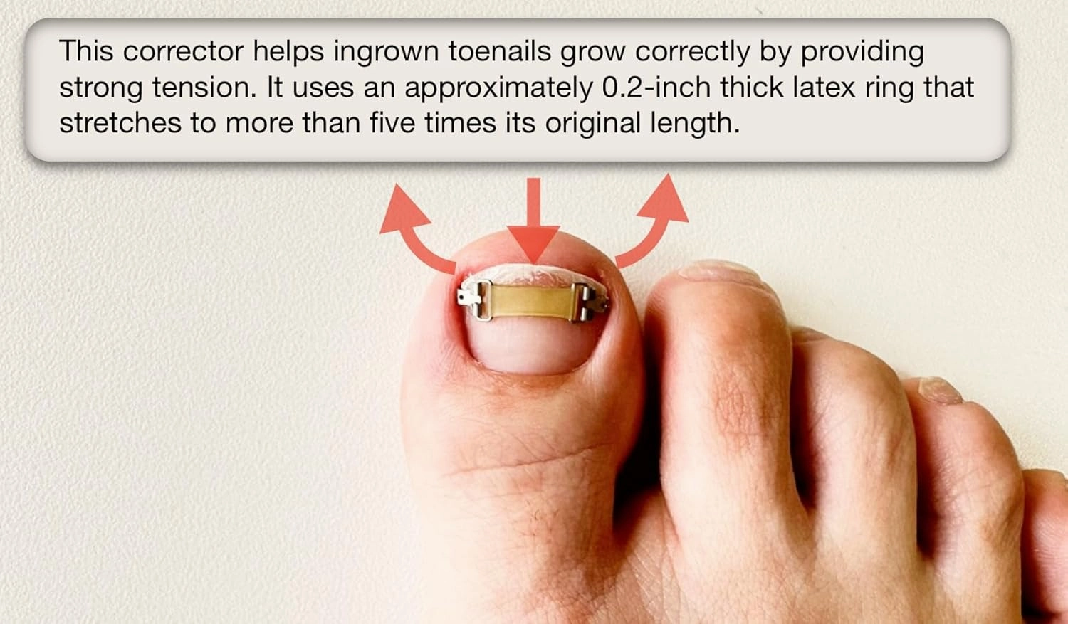 Ingrown Toenail Treatment & Corrector with Latex Elasticity - Curved Toenail Straightener | Effective Daily Solution for Ingrown Toenail Pain & Growth Correction [XL/0.87inches/21-23mm]